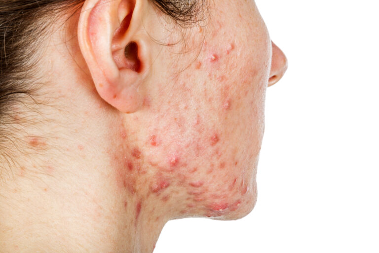 Acne conglobata im Gesicht und am Hals