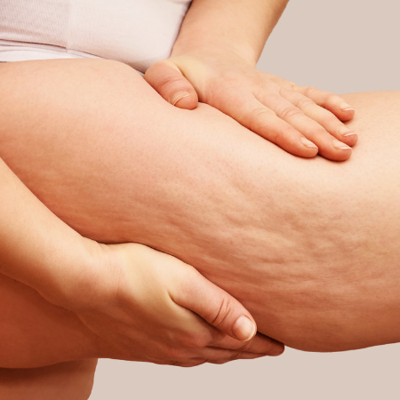 Cellulite loswerden