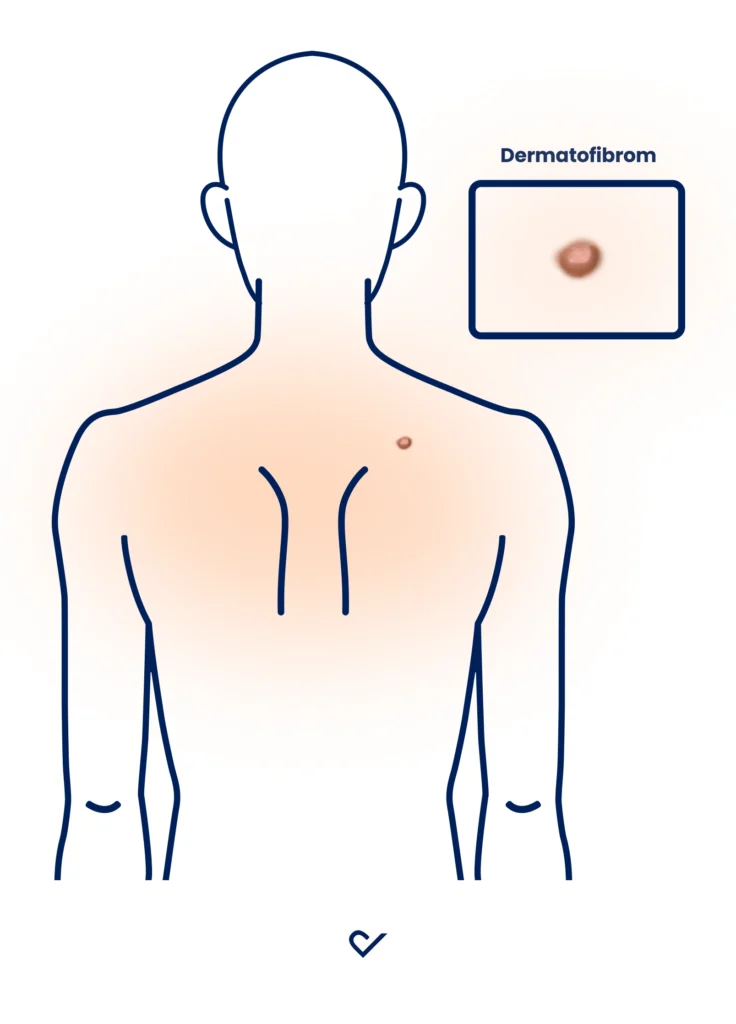 Bild Dermatofibrom Rücken