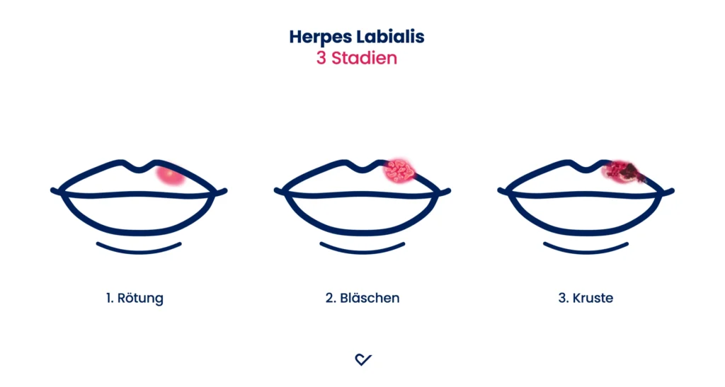 Bild Lippenherpes Stadien