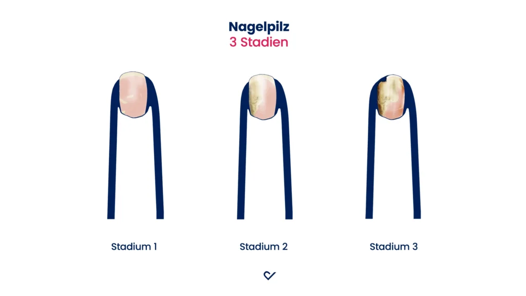 Bild Nagelpilz Stadien