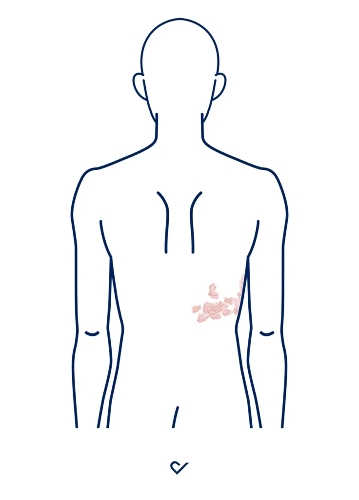 Bilder Gürtelrose Rücken Herpes Zoster