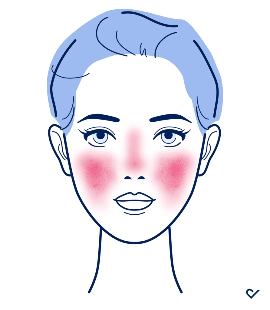 Rosacea_Rosazea Gesicht Frau