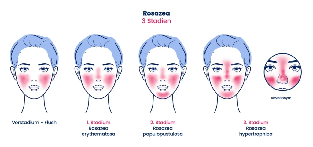 Bilder Rosazea Stadien