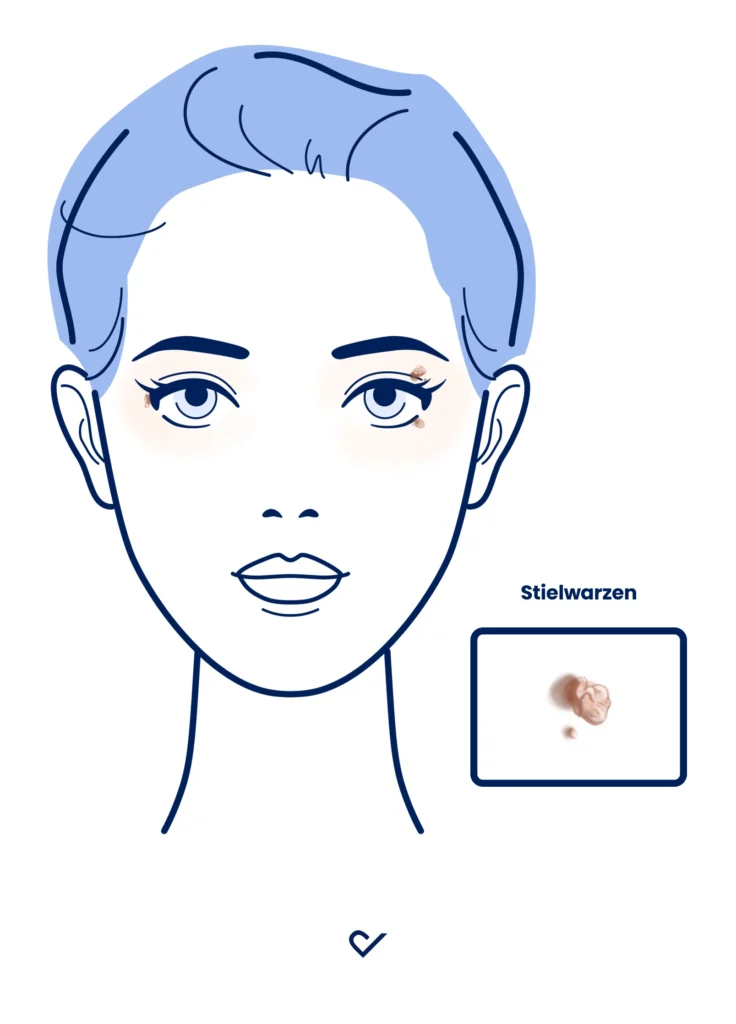 Bild Stielwarze_Fibrom