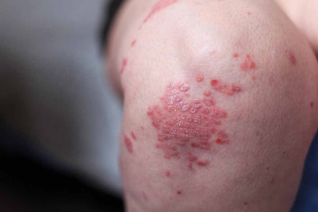 Psoriasis guttata (Eruptiv-exanthematische Psoriasis vulgaris; guttate psoriasis; Psoriasis guttata-Typ; Psoriasis vulgaris akut-eruptive Form)