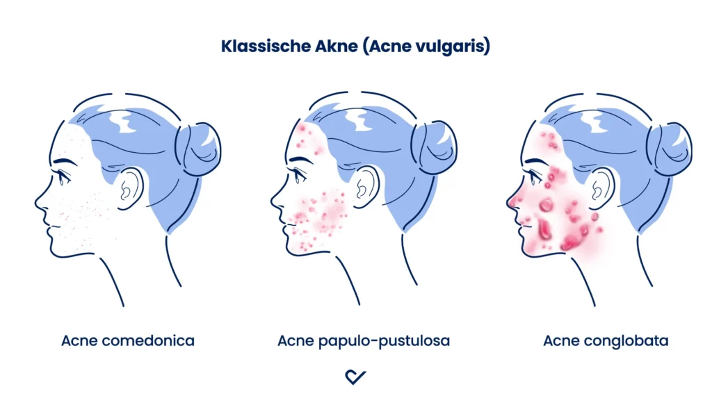 Übersicht mit Bildern zu den drei Formen der klassischen Akne