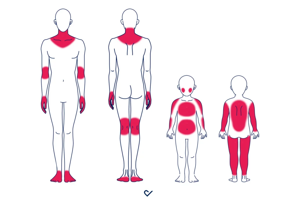 Neurodermitis betroffene Bereiche am Körper