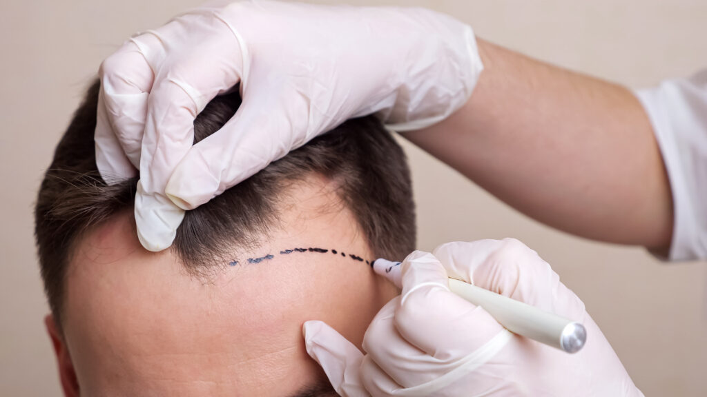 medical professional with gloves draws a dotted line on the head of a balding man