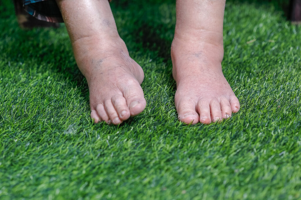 Elderly woman bare swollen feet on grass