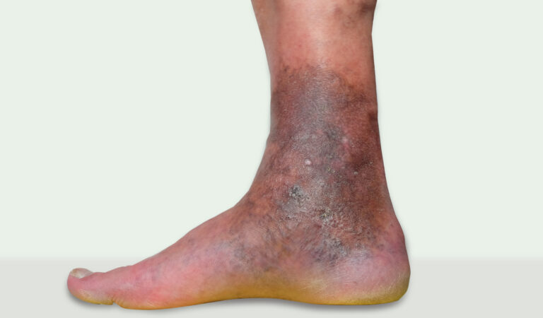 varicose veins leg ulcers