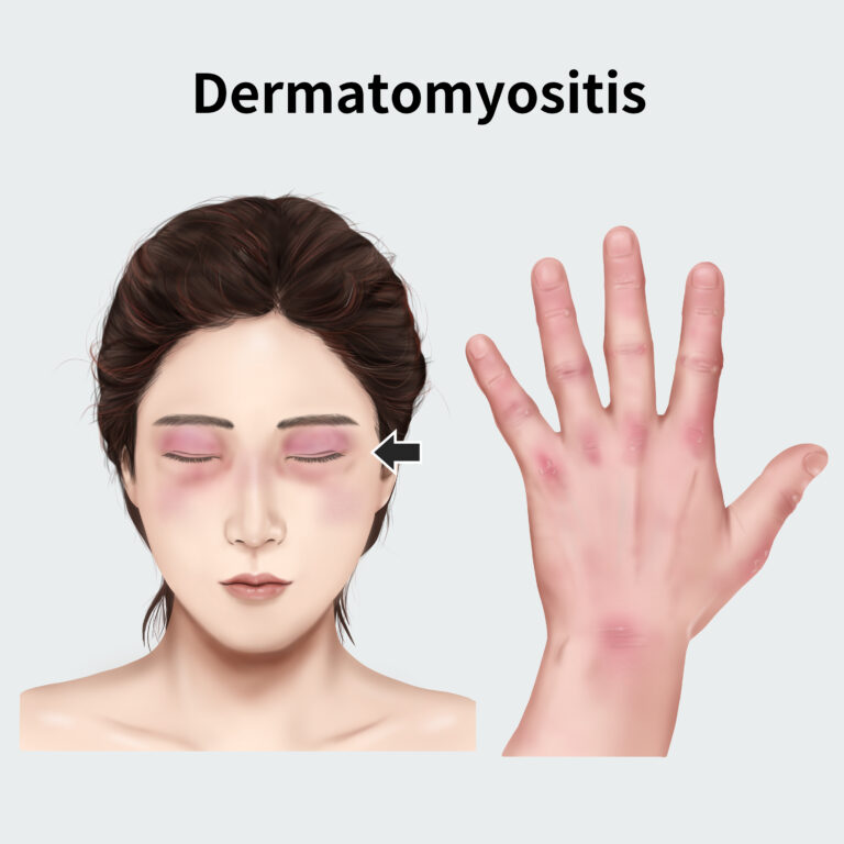 Dermatomyositis